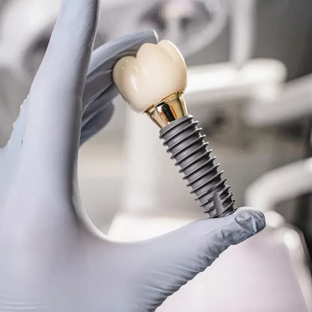 3D illustration of a dental implant placed in the jaw, offered at Cleopatra Dental Riverside