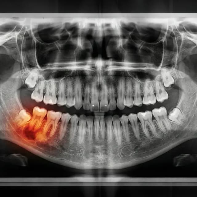 Hygienist performing a routine teeth cleaning and digital X-ray at Cleopatra Dental Riverside